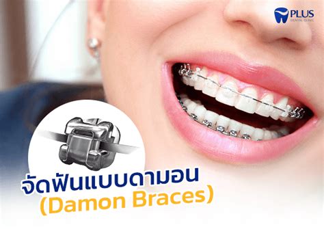 จัดฟันแบบดามอน Damon Braces คืออะไร ราคาเท่าไหร่