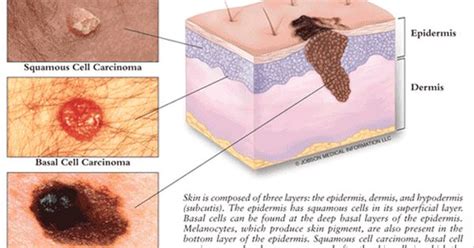 A basal cell lesion is often described as a pearly papule because if basal cell carcinoma is left untreated, the lesions can grow and may eventually ulcerate (break like other types of cancer, bcc is caused by mutations, which are changes in the molecular. Nodular Melanoma Pictures | Melanoma and Non-Melanoma Skin ...