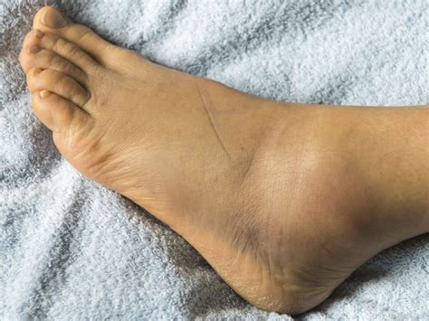Swollen Ankles 11 Causes And How To Treat Them