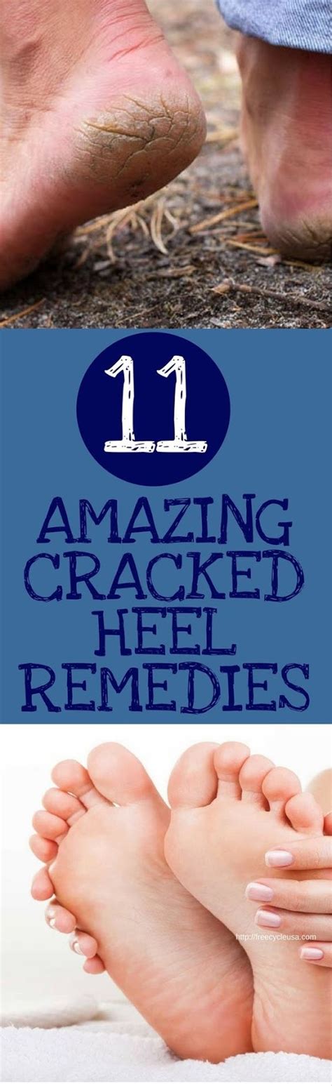 11 Amazing Cracked Heel Remedies Diy And Craftiness