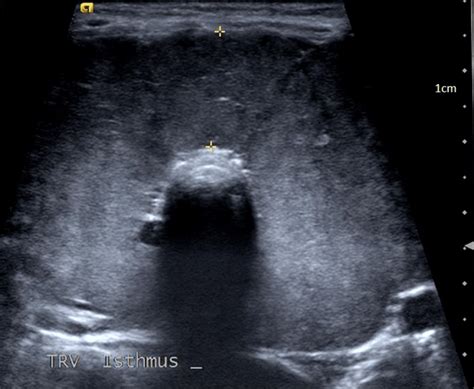 Thyroid Ultrasound Significant For Bilateral Lobe Enlargement