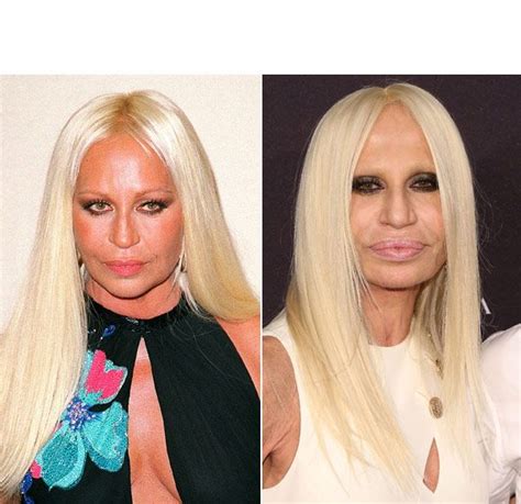 Donatella Versaces Shocking Plastic Surgery Makeover Experts Speak CELEBRITY Beauty