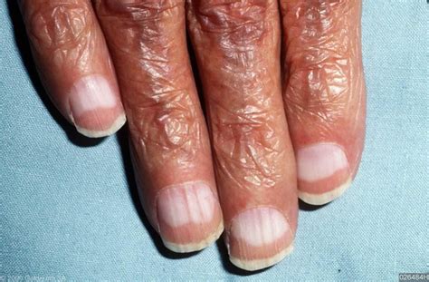 Terrys Nails Sign Of Liver Disease Nail Signs Nails Liver Disease