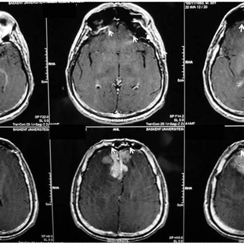 A And B Preoperative Sagittal And Axial T1 Weighted Mri Scan