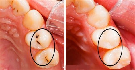 Molars are more vulnerable to decay than the front teeth. WOW! 5 amazing ways to heal tooth decay and reverse ...