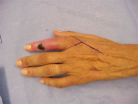 Vascular Ray Amputation For Traumaticischemic Finger Ulceration With