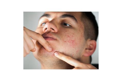 Infected Pimples What Are They And How To Deal With Them