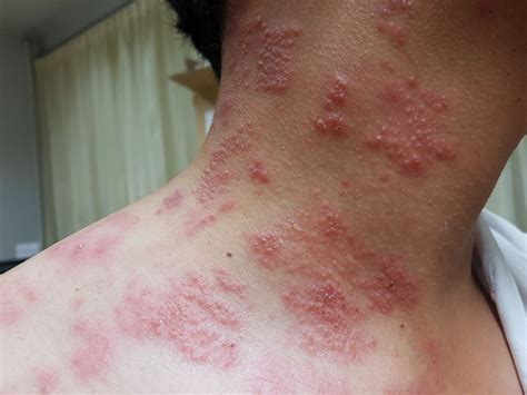 Shingles Skin Bumps What Causes Shingles Itchy Bumps