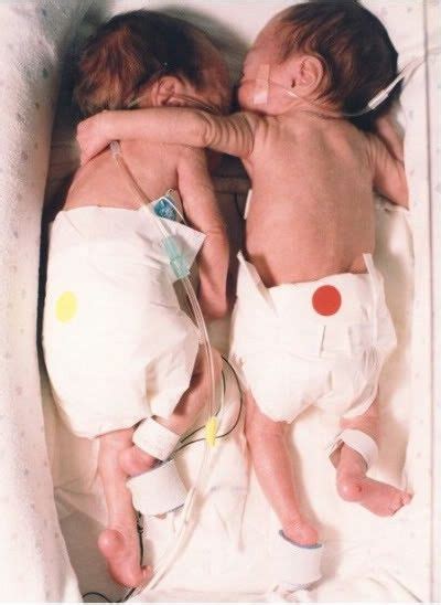 The Rescuing Hug This Is An Amazing Story Of Twin Baby Girls One