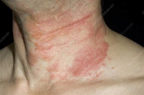 Eczema On Neck Images Frompo 1