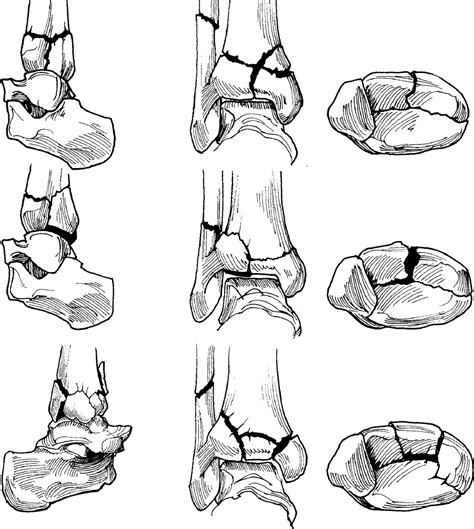 Distal Tibia Fractures Radiology Key