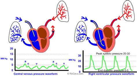 Learn Anesthesia And Have Fun Pulmonary Artery Pressure Monitoring