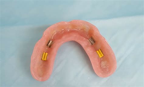 Implant Dentures Complete