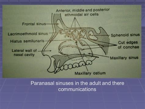 Posterior Wall Maxillary Sinus