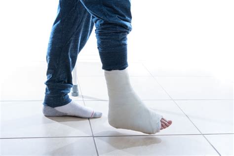 New Plaster Cast May Help Seniors Avoid Surgery For Ankle
