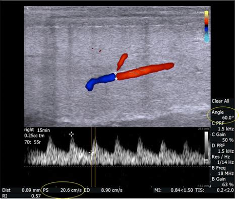 Penile Doppler Ultrasound Predicting Cardiovascular Disease In Men With