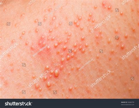 Allergic Rash On The Body Of The Patient Stock Photo 50688799