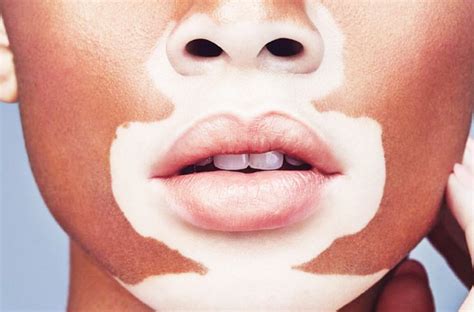 Natural Remedies For Lip Vitiligo — Healthy Builderz