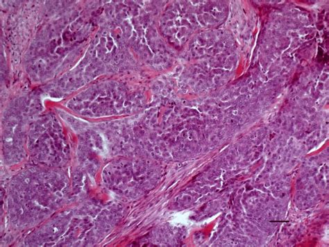 Canine Apocrine Sweat Gland Carcinoma Solid Type Densely Packed