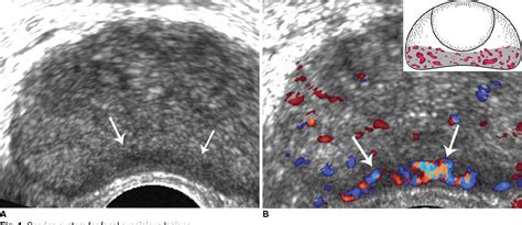 Figure From Classification Of Focal Prostatic Lesions On Transrectal Ultrasound Trus And The