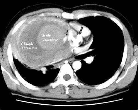 Axial Post Contrast Ct Section Of Chest Showing The Large Download