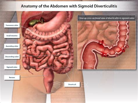 Anatomy Of The Abdomen With Sigmoid Diverticulitis Trial Exhibi