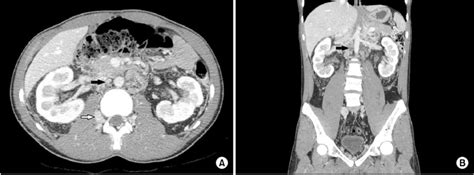 Contrast Abdomen And Pelvic Ct Scan A Transverse Ct Section Showed