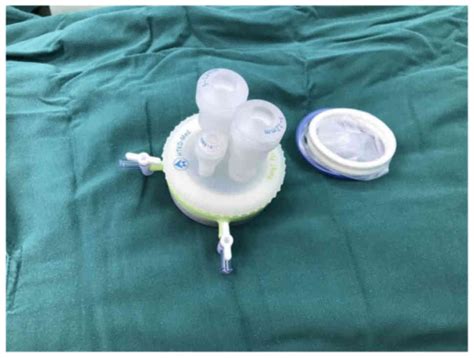 Singleincision Surgery For Gynecomastia Using Triport A Case Report
