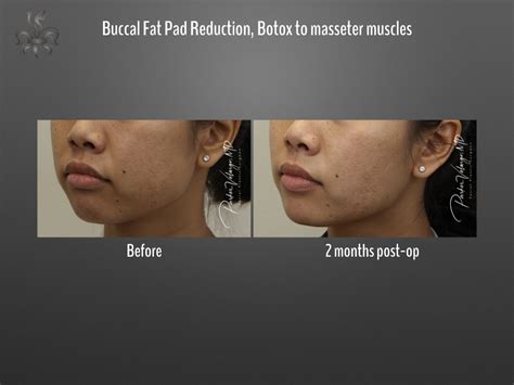 Buccal Fat Removal Case 3641 New Orleans Premier Center For