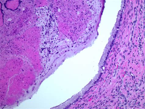 Cervical Cyst