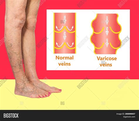 Varicose Veins On Image And Photo Free Trial Bigstock