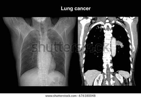 Would A Ct Scan Show Lung Cancer Ct Scan Machine