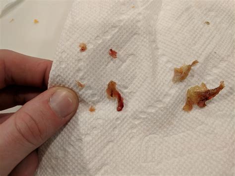 The mucus and your nose hairs are working in tandem to trap dirt and other gross things from being if boogers get really dry and crusted against the walls of your nasal canal, it's a recipe for a bloody nose. Nasal polyp? Huge blown out nose, right 2 from the R, left ...