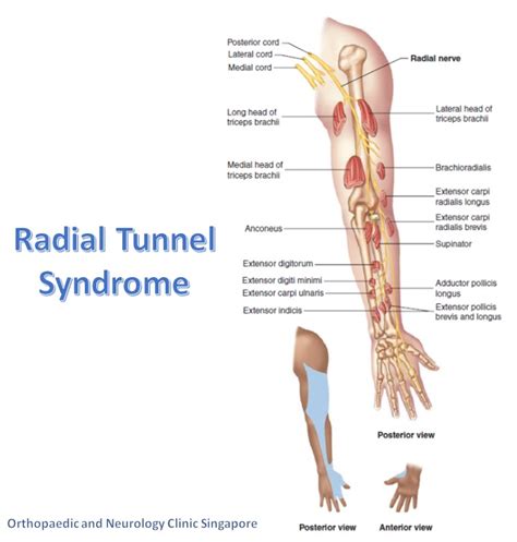 Radial Tunnel Syndrome Cure Reliable Wrist Clinic