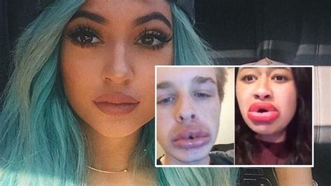 How To Get Kylie Jenner Lips With A Bottle Cap