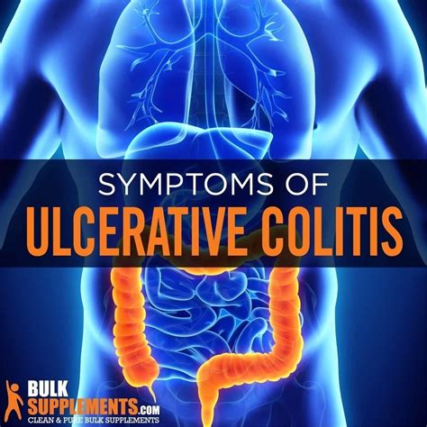 Tablo Read Ulcerative Colitis Symptoms Causes Treatment By