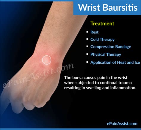 Wrist Bursitiscausessymptomstreatmentphysical Therapyexercises