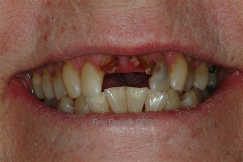Little child smiling missing front tooth. Dental Bridge|Bridge Dentistry|Sedona AZ Dentist