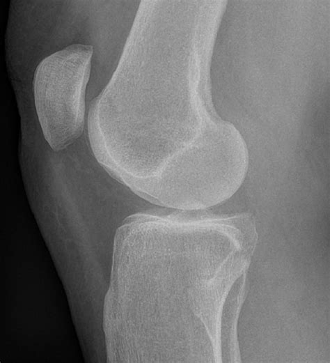 Knee Patellar Dislocation X Ray