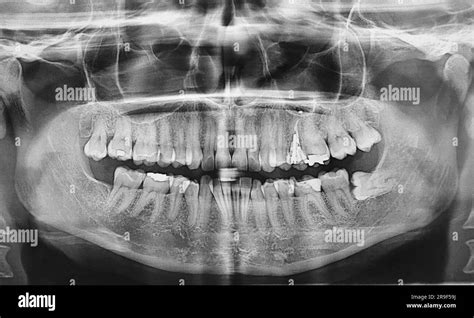 Dental X Ray With Impacted Wisdom Tooth Stock Photo Alamy