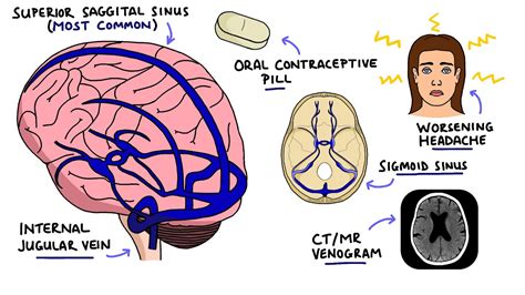 Cerebral Venous Sinus Thrombosis Cvst With Dural Venous Sinuses