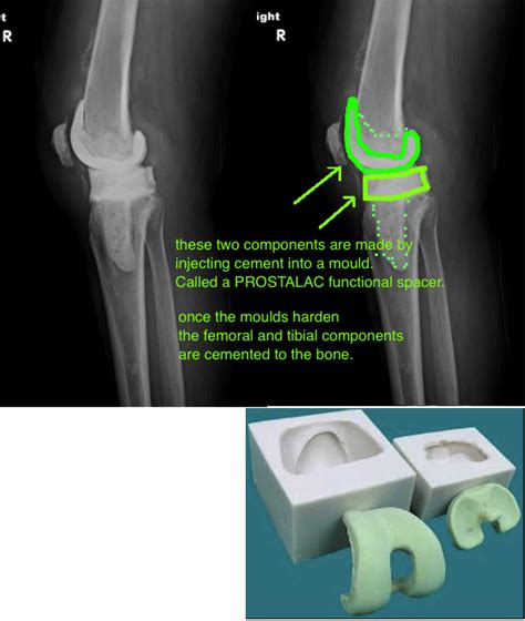 Prosthetic Joint Infection — Hip And Knee Book