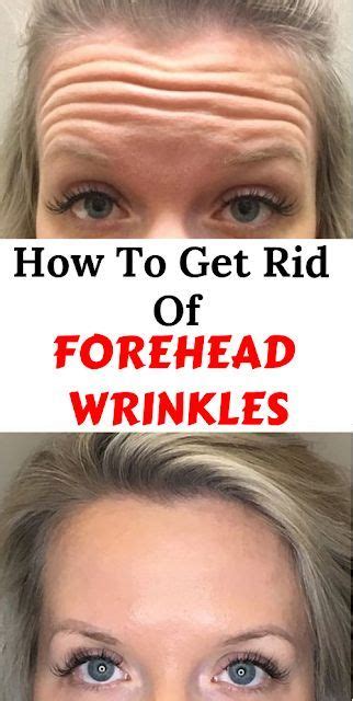 How To Get Rid Of Forehead Wrinkles Forehead Wrinkles Skin Care Wrinkles Wrinkle Remedies