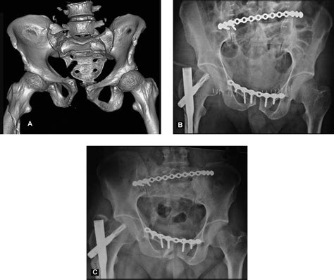 Posterior Tension Band Plate Osteosynthesis For Unstable Sacral