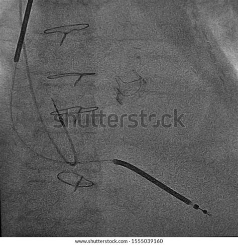X Ray Image Showed Prosthetic Heart Stock Photo 1555039160 Shutterstock
