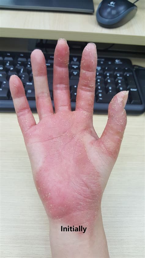 Pompholyx Eczema Treatment With Chinese Medicine Chinesedocsg
