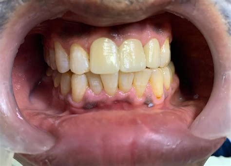 This staining can be difficult to aspirin contains acetylsalicylic acid and will also be able to get the stain off your fingers. How to get rid of smoking stains on teeth?