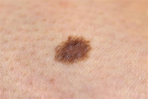 Is It Normal For A New Mole To Appear Causes And Warning Signs