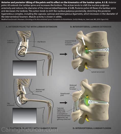 Treatments For Leg Length Discrepancy Pelvic Tilt Pelvic Incidence