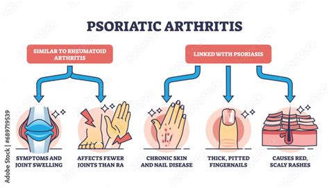Psoriatic Arthritis As Chronic Dermatological Skin Condition Outline